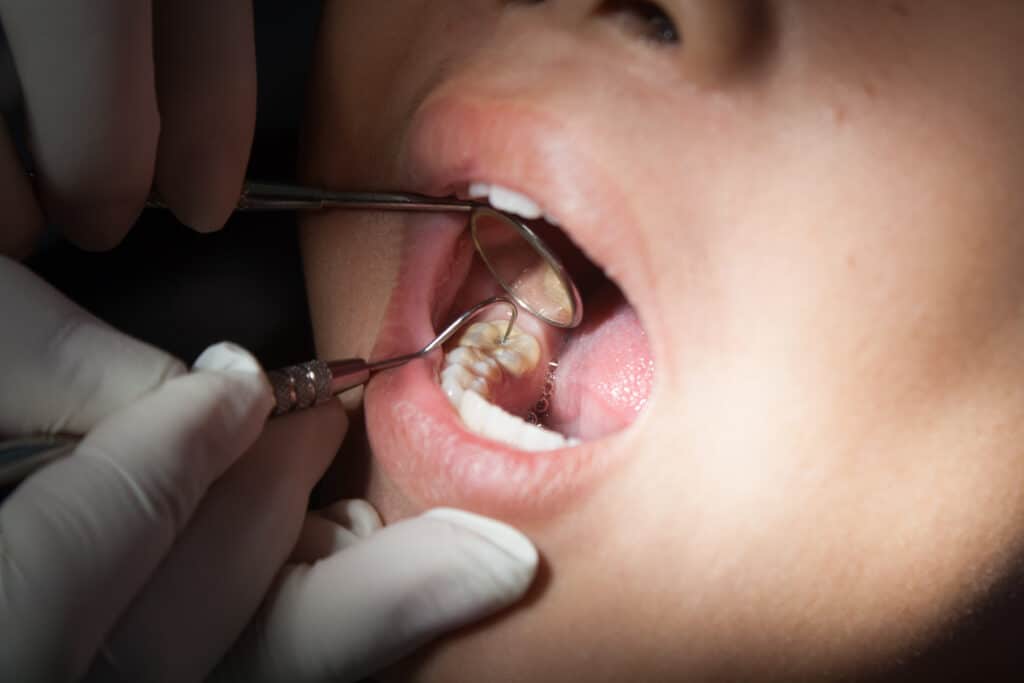 Dental-sealent-in-Mission-Valley-CA-1024x683