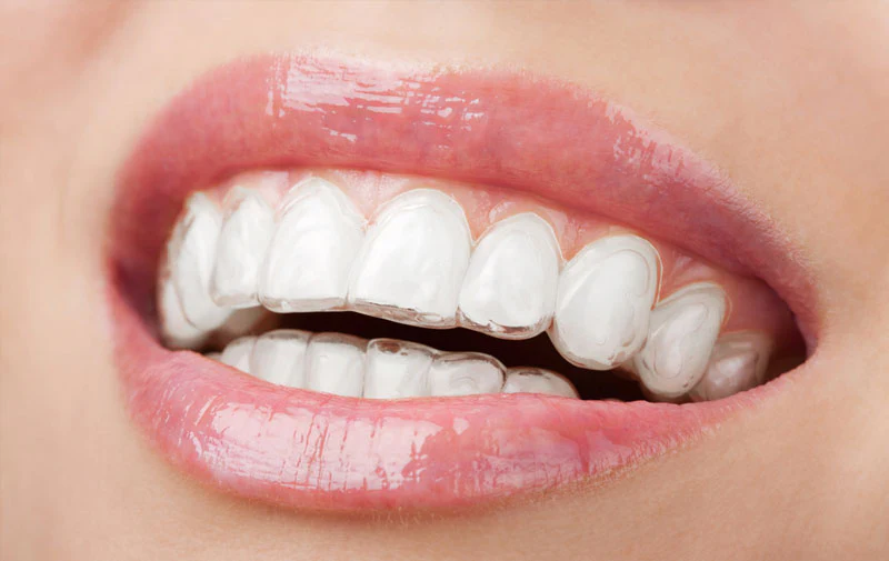 invisalign-braces